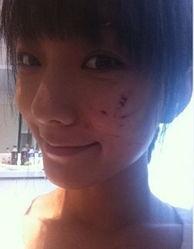 额头缝针可以吃网瓜,网瓜助力康复之旅